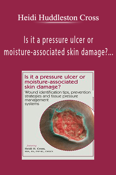 Heidi Huddleston Cross – Is it a pressure ulcer or moisture–associated skin damage? Wound identification tips